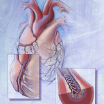 Sam Collins, Amy Collins, coronary artery disease, medical illustration, medical illustrator, cardiology, heart, medical art, illustration, healthcare