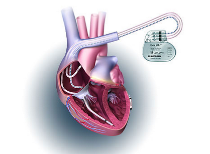 Cardiac device