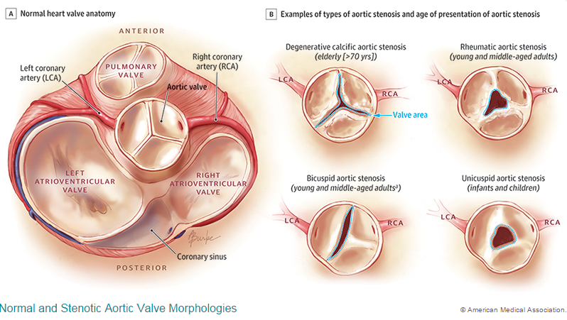 Stenotic Aortic Valve Morphologies