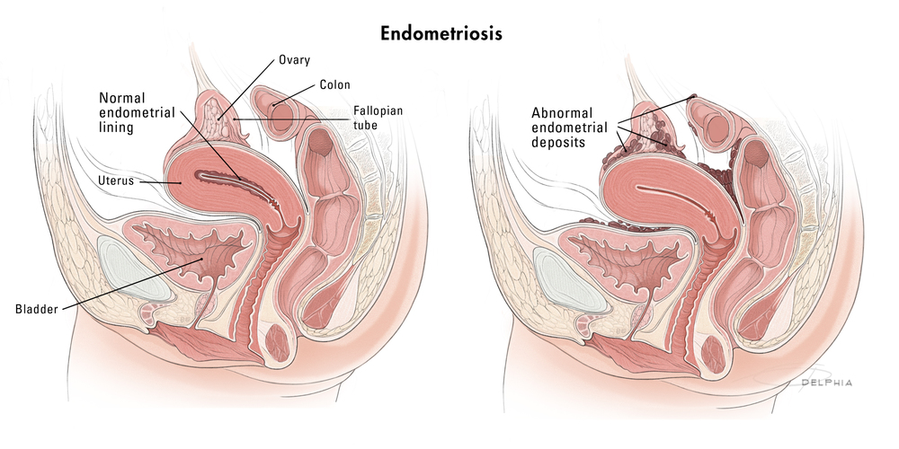 Endometriosis, Catherine Delphia, MA, CMI