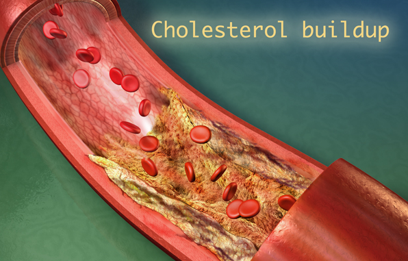Cholesterol - Echo Medical Media