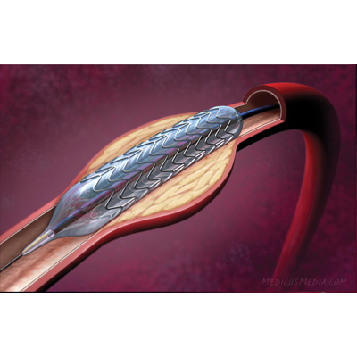 Balloon-Expandable Stent