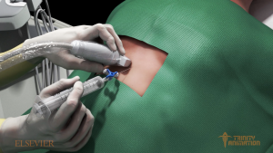This is a 3D rendered image from medical animations showing doctors hands coming from the left side of the screen and performing a needle insertion into the pericardial sac on the back of a patient. This image specifically displays the hyper realistic textures of the 3D materials.