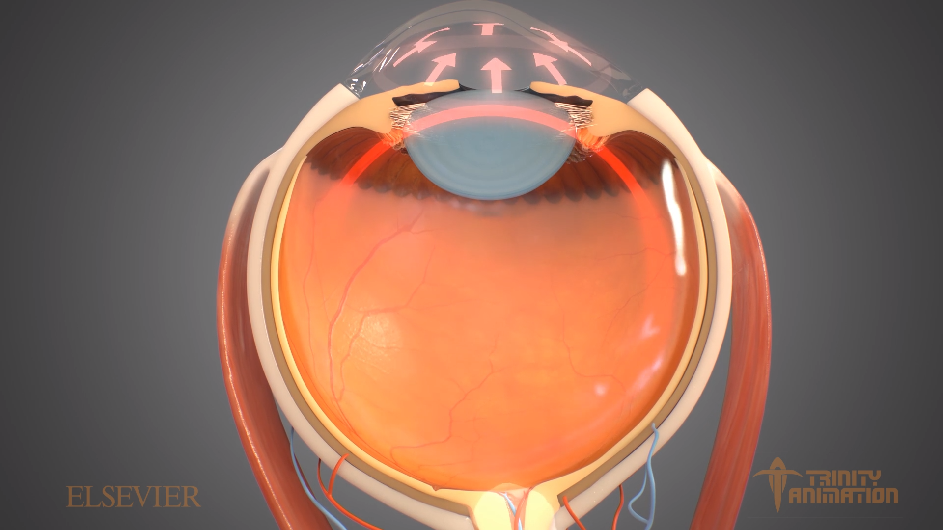 In Trinity's surgical animations, manipulated imagery of the eye sliced in half display interior elements of the eye and demonstrate how the eye's drainage canals become clogged over time, causing an increase in internal eye pressure and subsequent potential damage to the optic nerve.