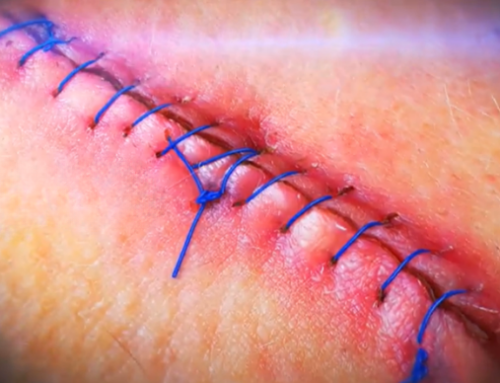 How did the invention of the subcutaneous suture affect scar formation?