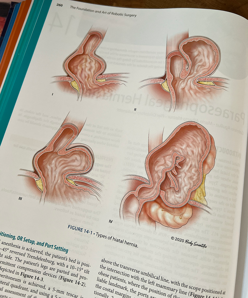 4 illustrations of different hiatal hernias